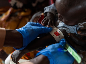 A child is assessed for malnutrition at a health facility in Um Sagour camp in Sudan.