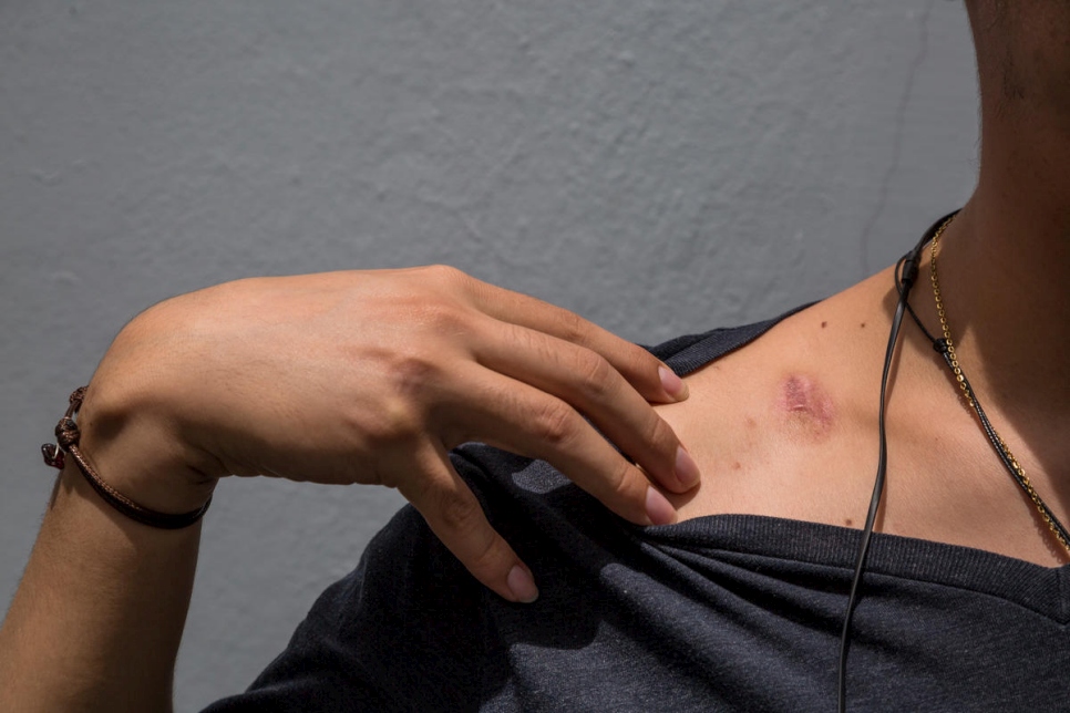 لوبو*، طالب الطب، 21 عاماً، يظهر الندوب الناتجة عن أعمال العنف التي يقول بأنه تعرض لها خلال الاضطرابات في نيكاراغوا.